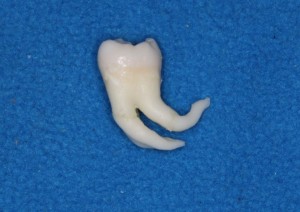 vytrhnuty-zub